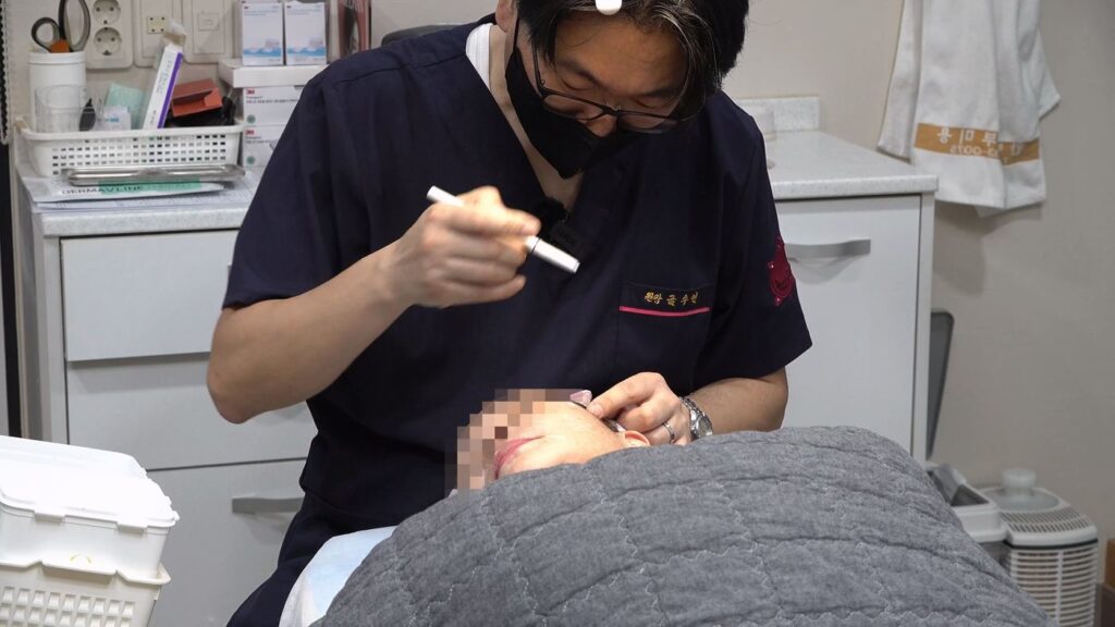 매선리프팅 시술 전 디자인 표시